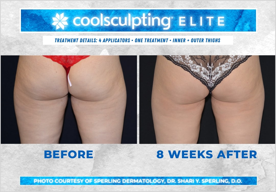 Before & After Thighs CoolSculpting in New Jersey