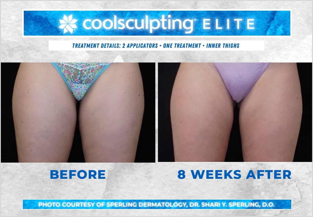 Before & After Thighs CoolSculpting in New Jersey