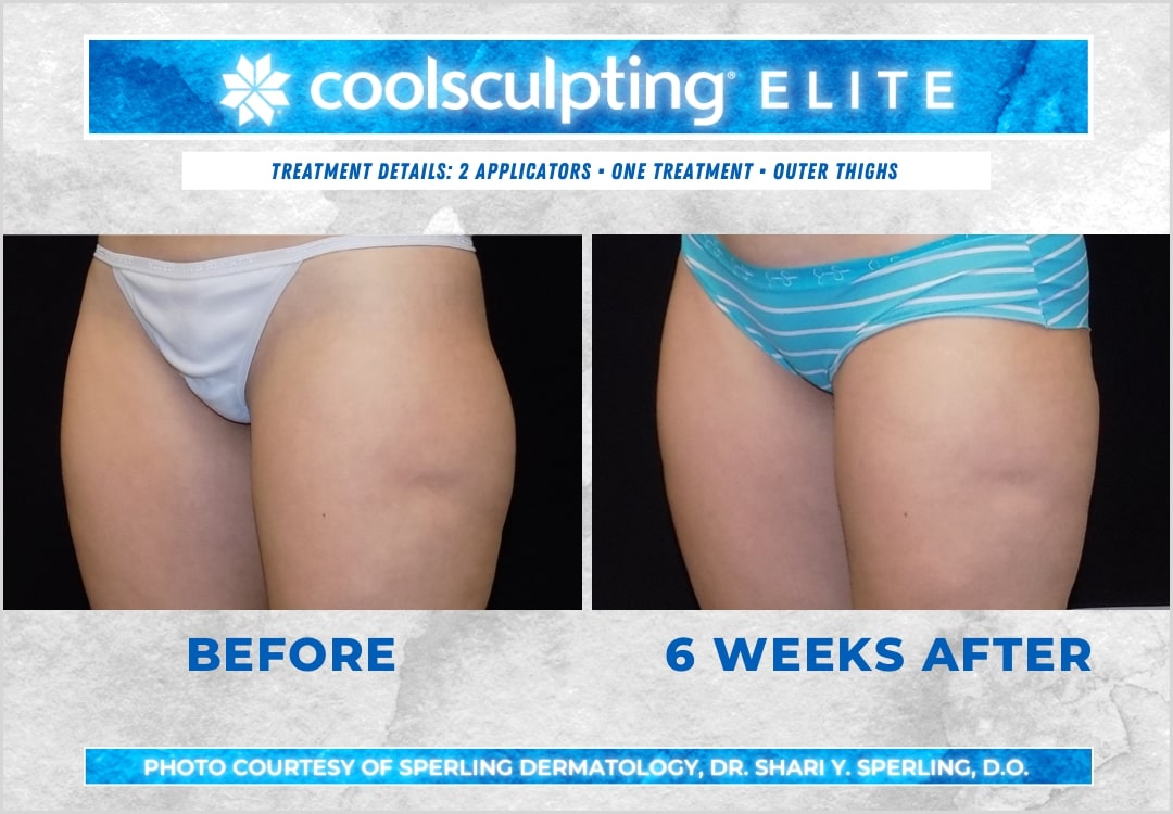 Before & After Thighs CoolSculpting in New Jersey