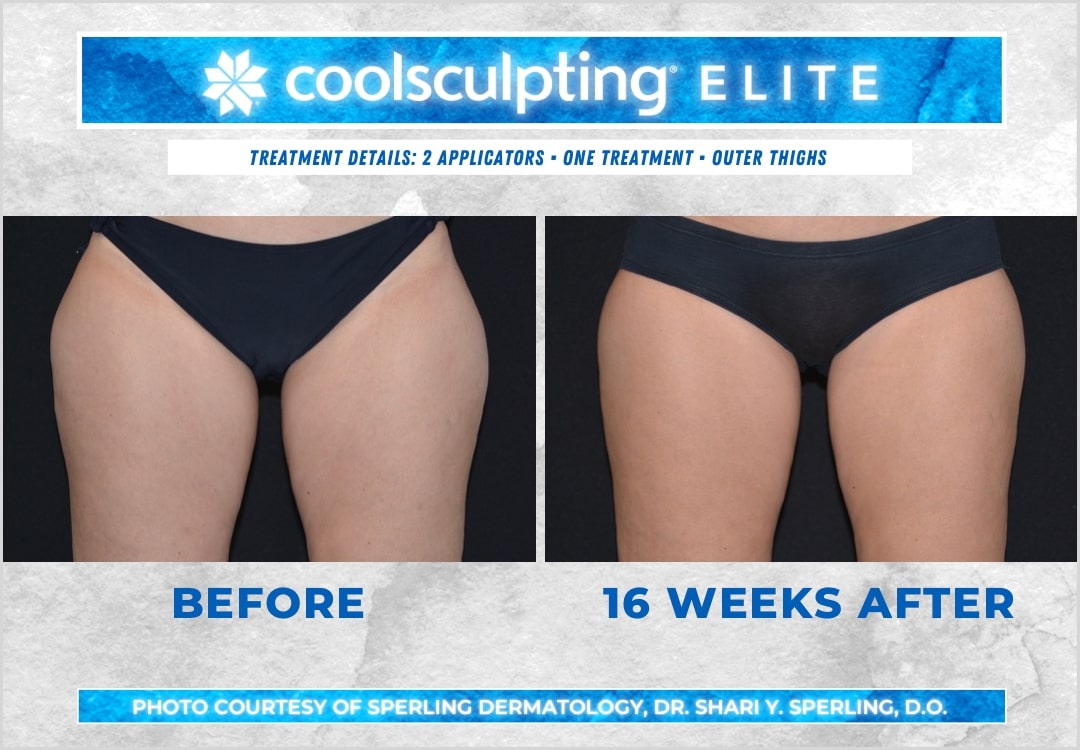 Before & After Thighs CoolSculpting in New Jersey