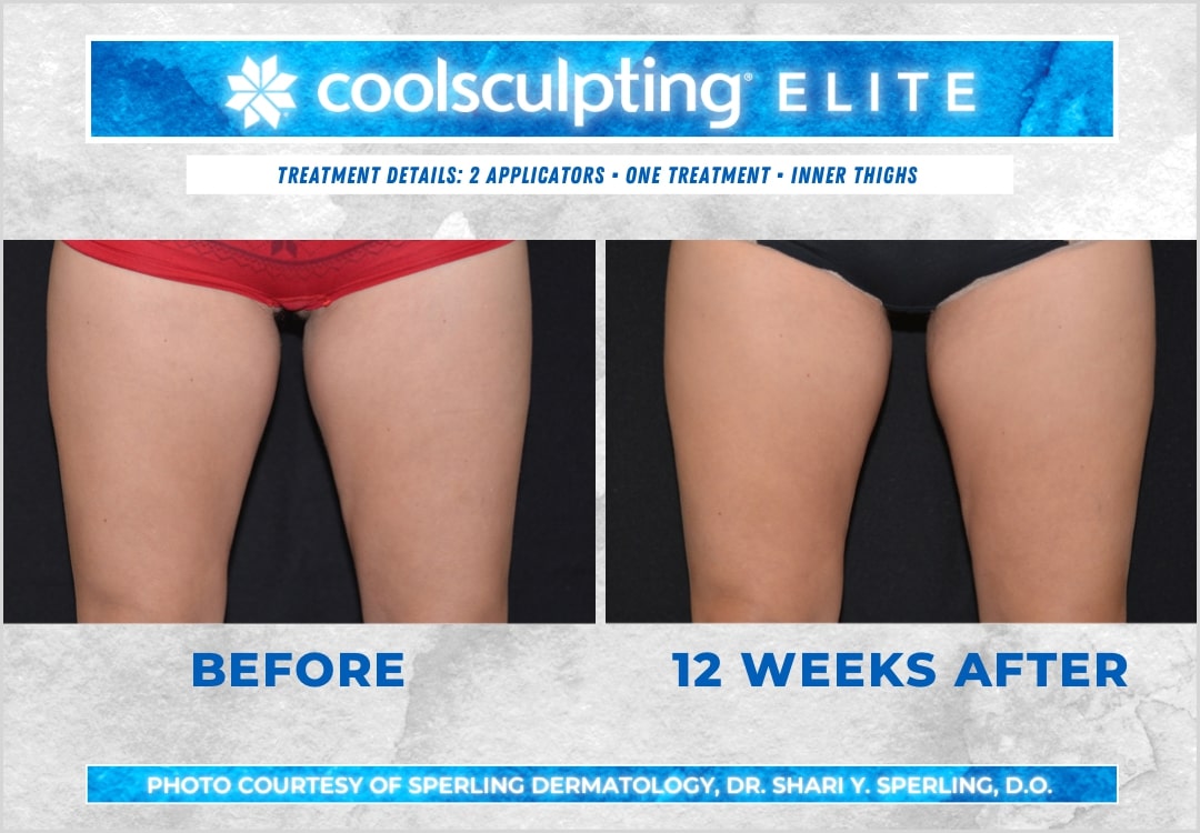 Before & After Thighs CoolSculpting in New Jersey