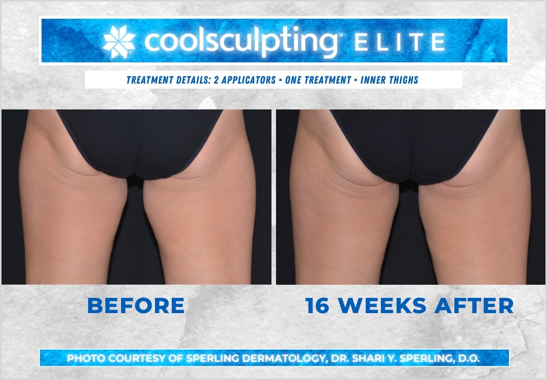 Before & After Thighs CoolSculpting in New Jersey