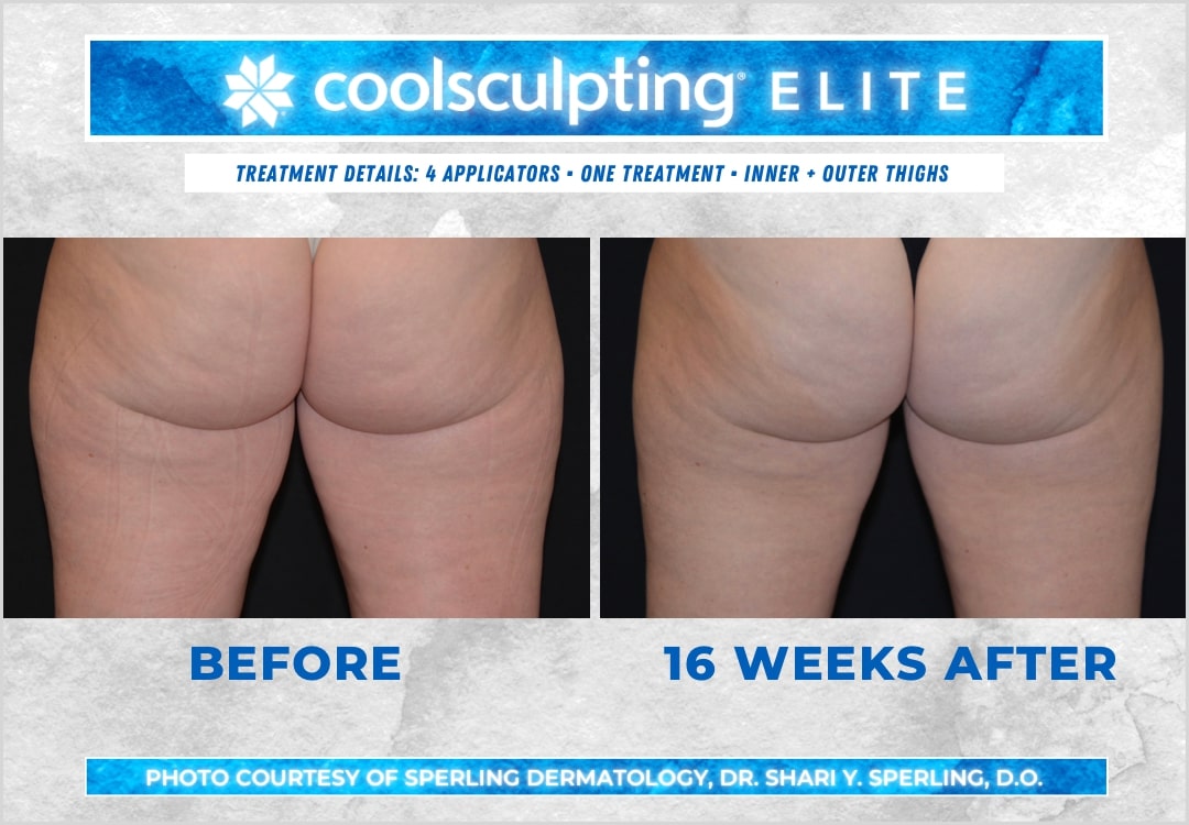 Before & After Thighs CoolSculpting in New Jersey