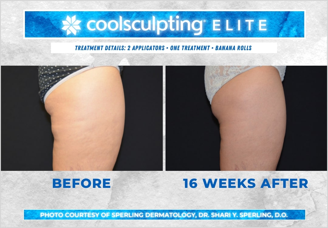 Before & After Thighs CoolSculpting in New Jersey