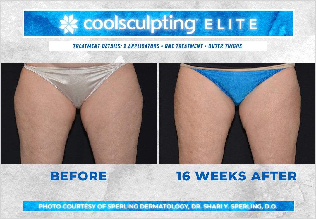 Before & After Thighs CoolSculpting in New Jersey