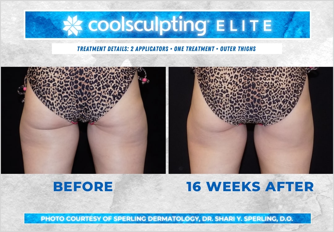 Before & After Thighs CoolSculpting in New Jersey