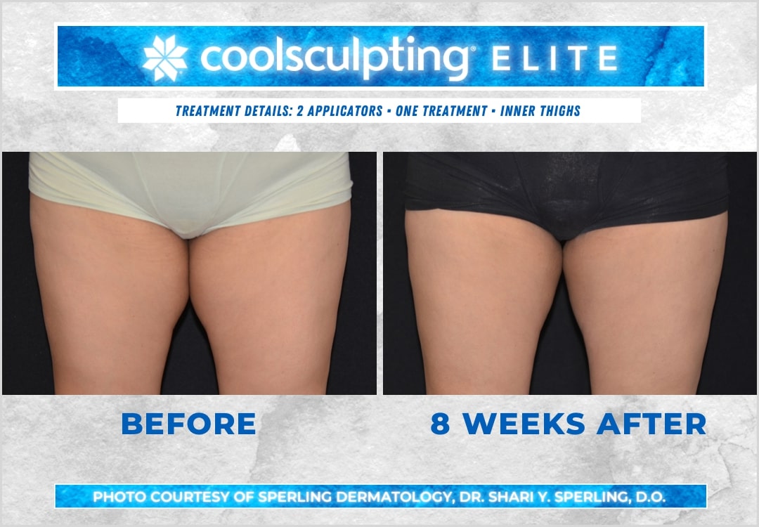 Before & After Thighs CoolSculpting in New Jersey