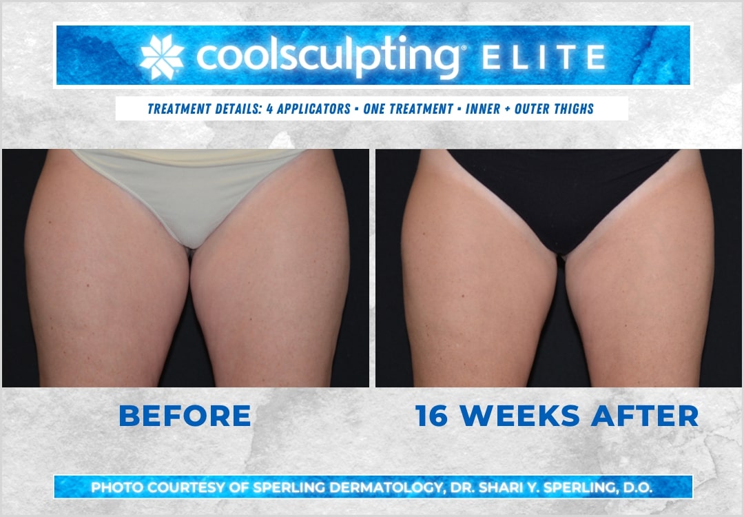 Before & After Thighs CoolSculpting in New Jersey