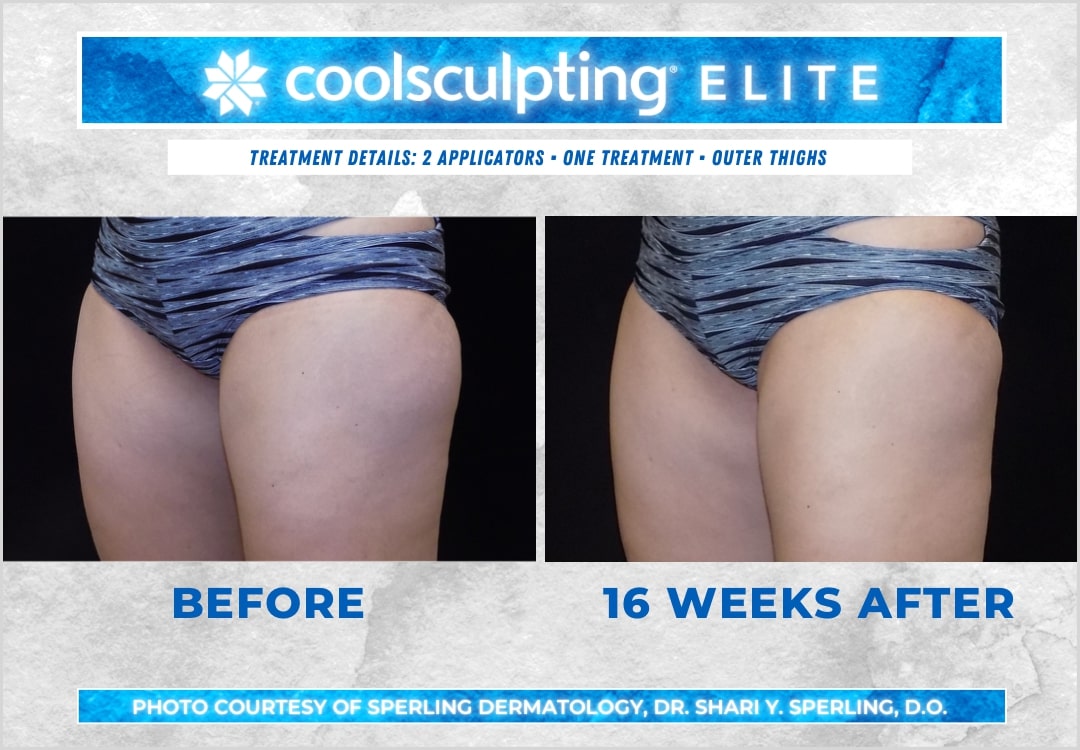 Before & After Thighs CoolSculpting in New Jersey