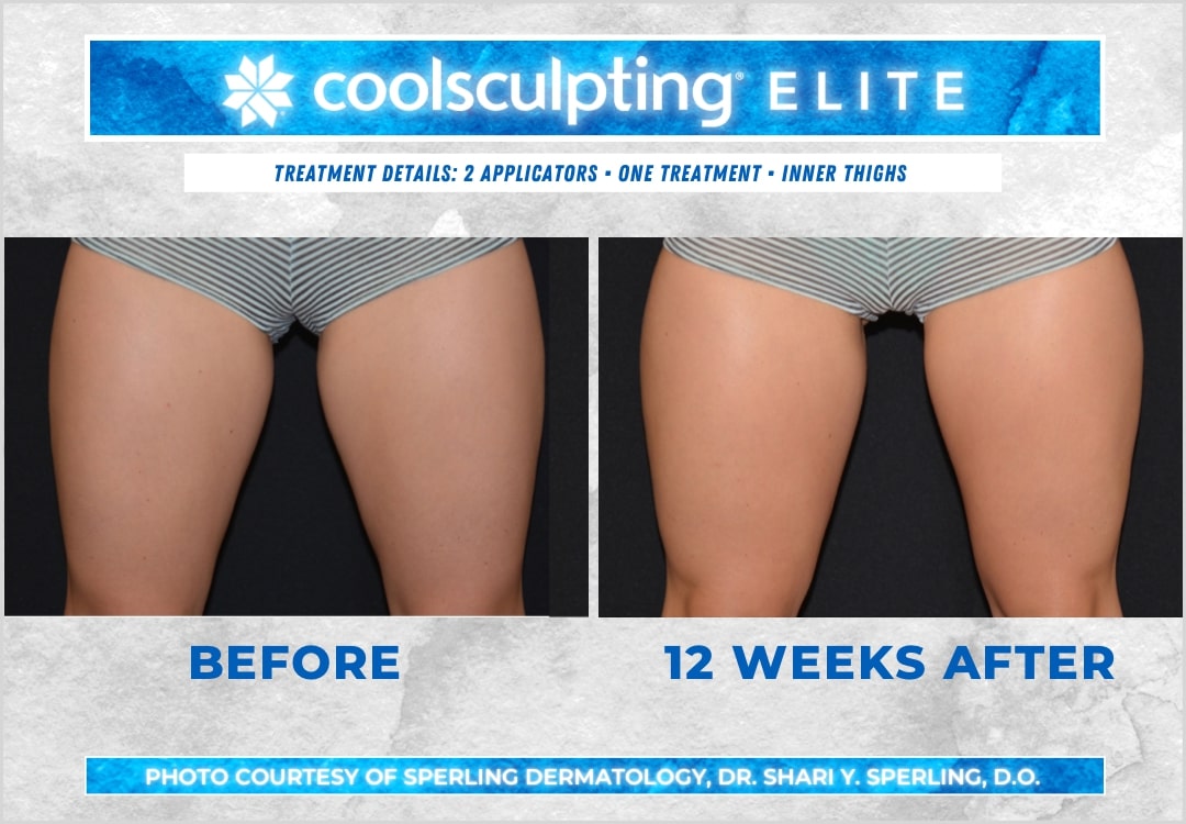 Before & After Thighs CoolSculpting in New Jersey