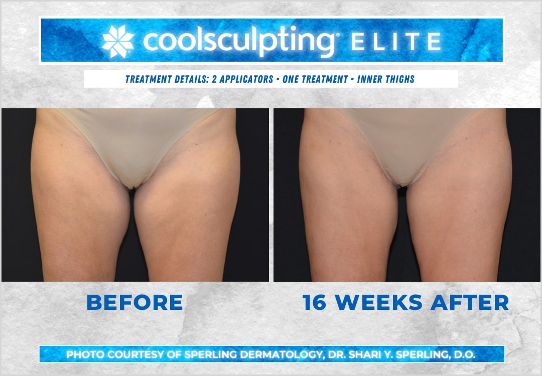 Before & After Thighs CoolSculpting in New Jersey