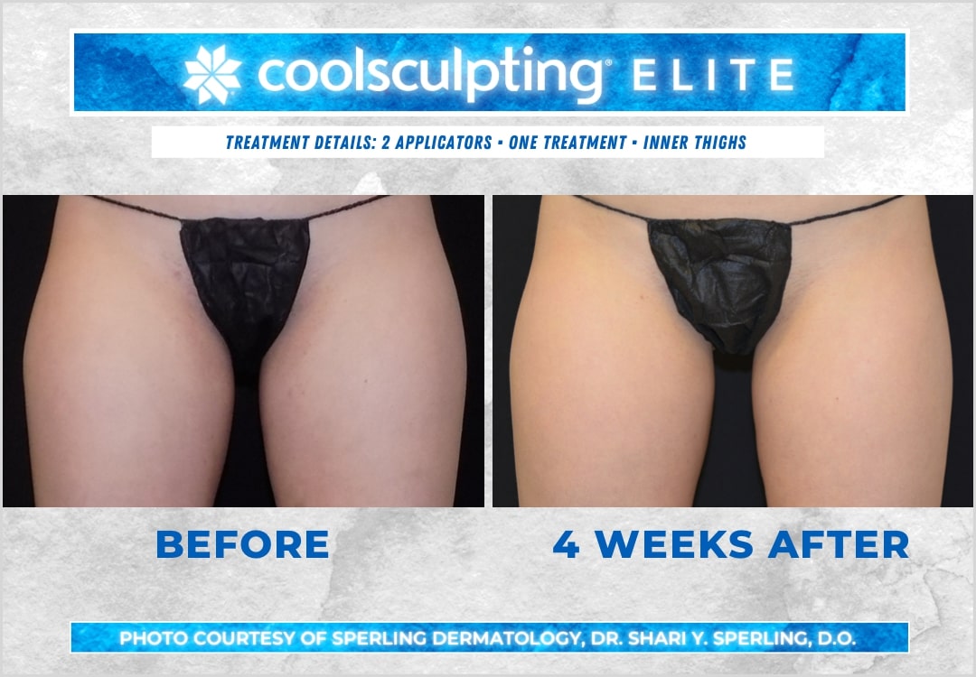 Before & After Thighs CoolSculpting in New Jersey