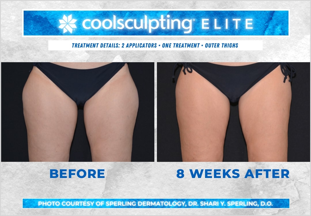 Before & After Thighs CoolSculpting in New Jersey