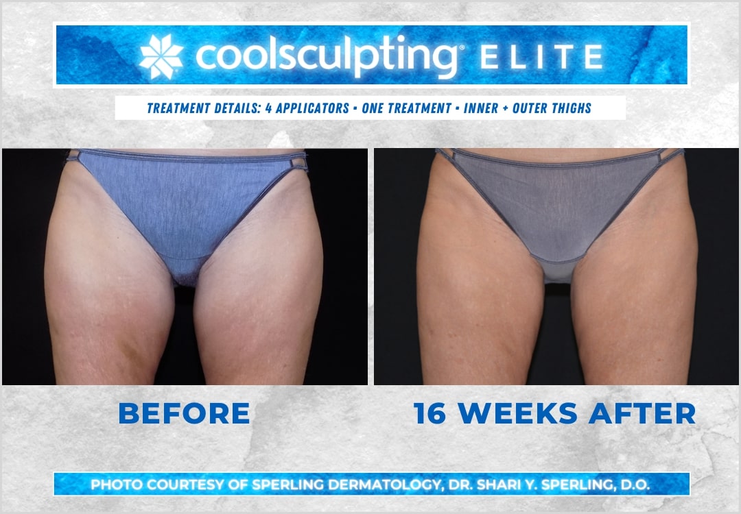 Before & After Thighs CoolSculpting in New Jersey