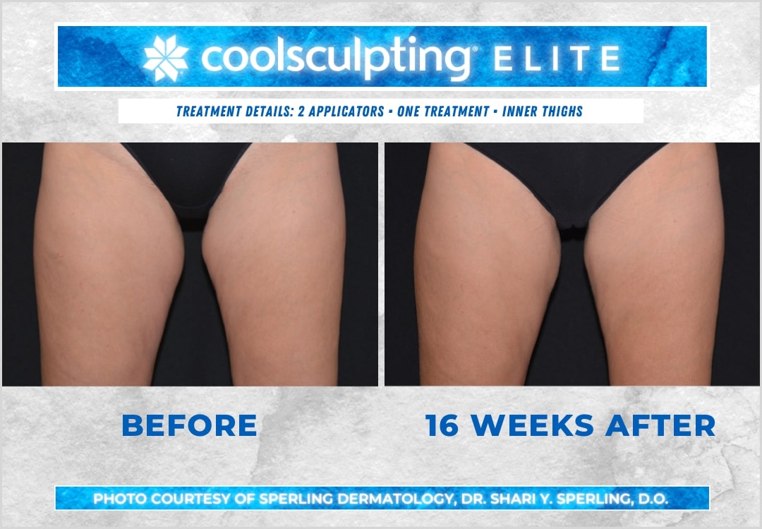 Before & After Thighs CoolSculpting in New Jersey