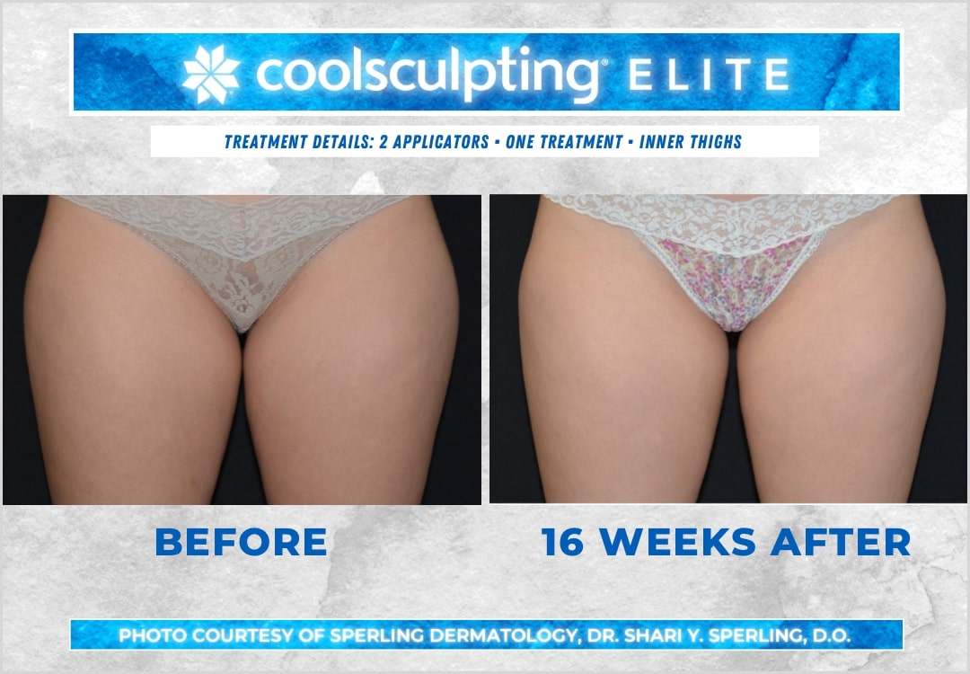 Before & After Thighs CoolSculpting in New Jersey