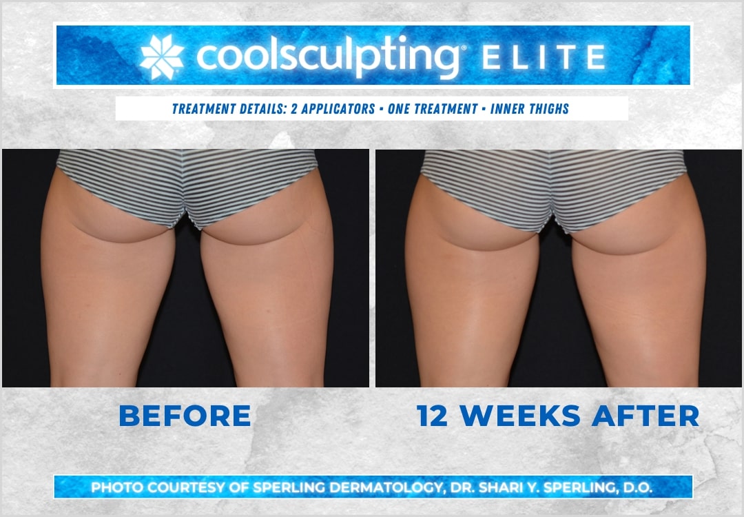 Before & After Thighs CoolSculpting in New Jersey