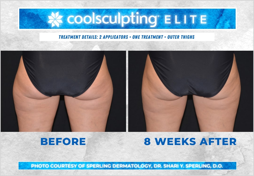 Before & After Thighs CoolSculpting in New Jersey