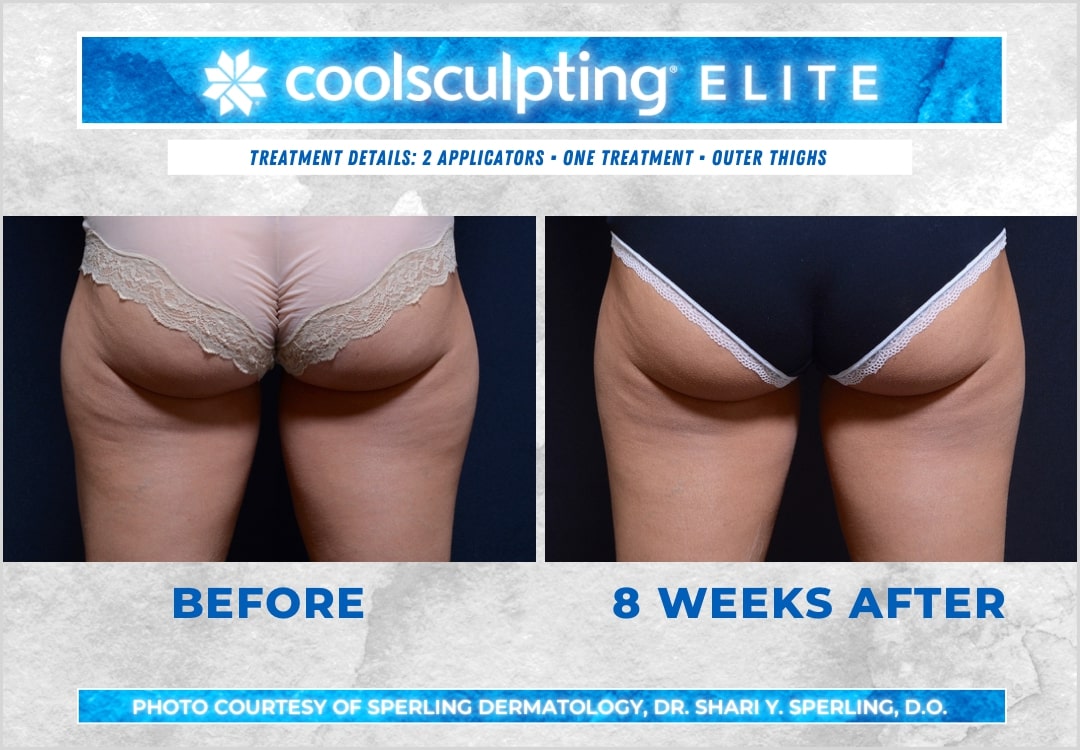 Before & After Thighs CoolSculpting in New Jersey