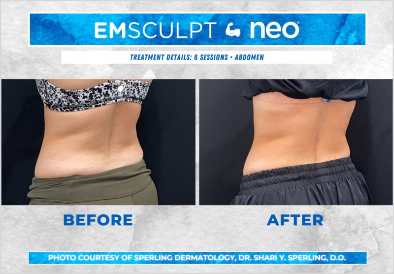 Before & After Abdomen Emsculpt NEO in New Jersey