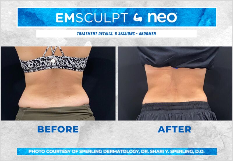 Before & After Abdomen Emsculpt NEO in New Jersey