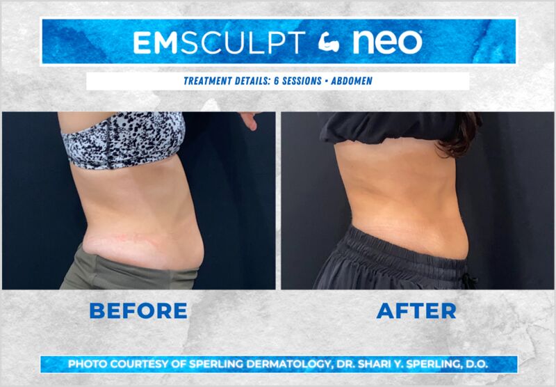 Before & After Abdomen Emsculpt NEO in New Jersey