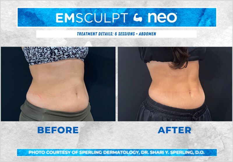 Before & After Abdomen Emsculpt NEO in New Jersey