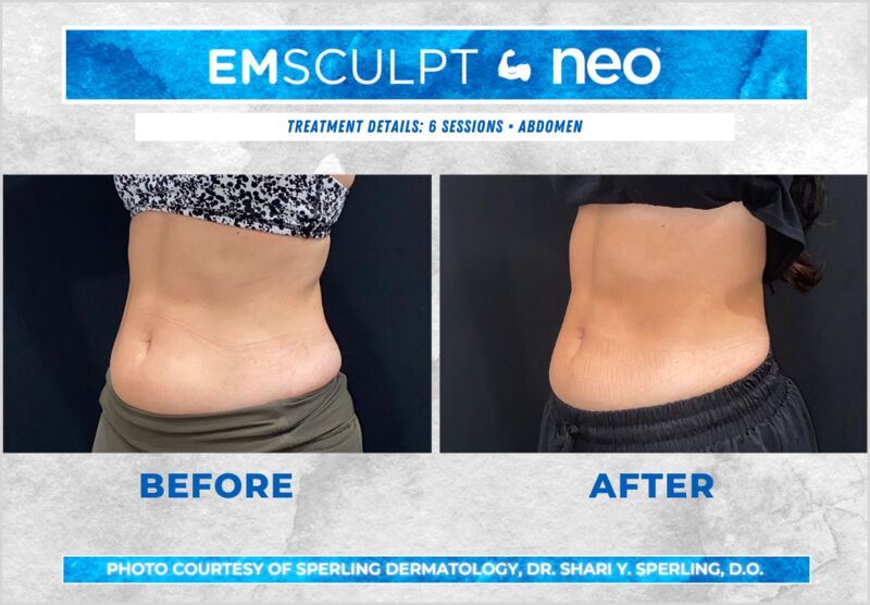 Before & After Abdomen Emsculpt NEO in New Jersey