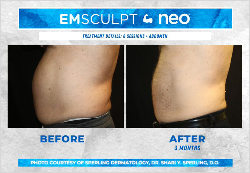 Before & After Abdomen Emsculpt NEO in New Jersey