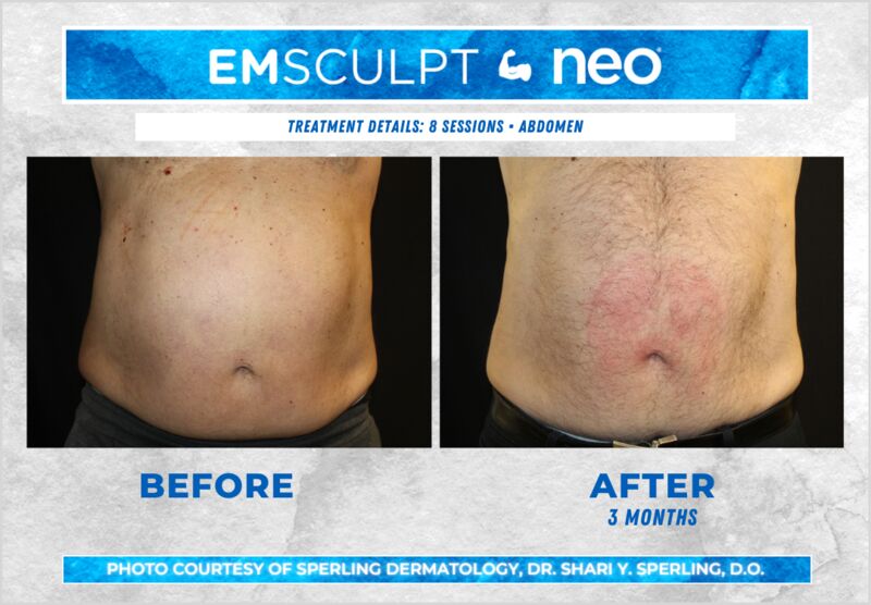 Before & After Abdomen Emsculpt NEO in New Jersey