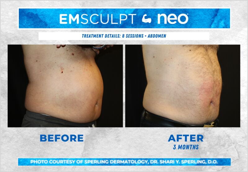 Before & After Abdomen Emsculpt NEO in New Jersey