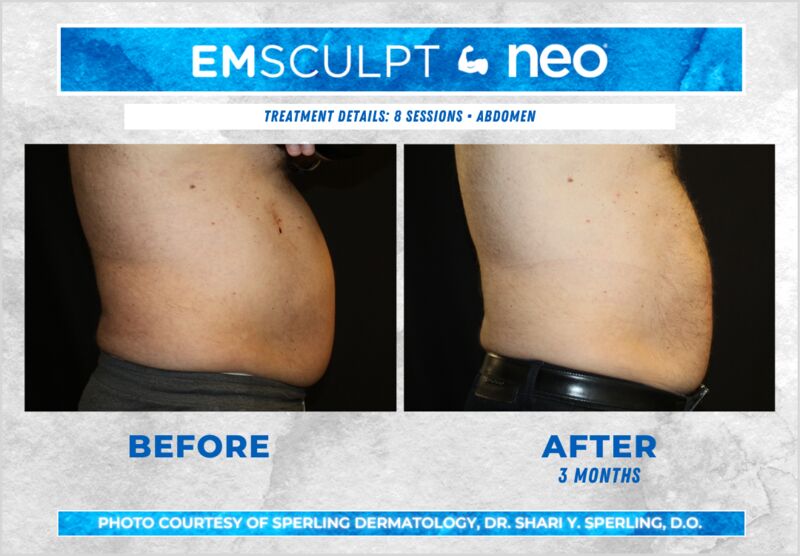 Before & After Abdomen Emsculpt NEO in New Jersey