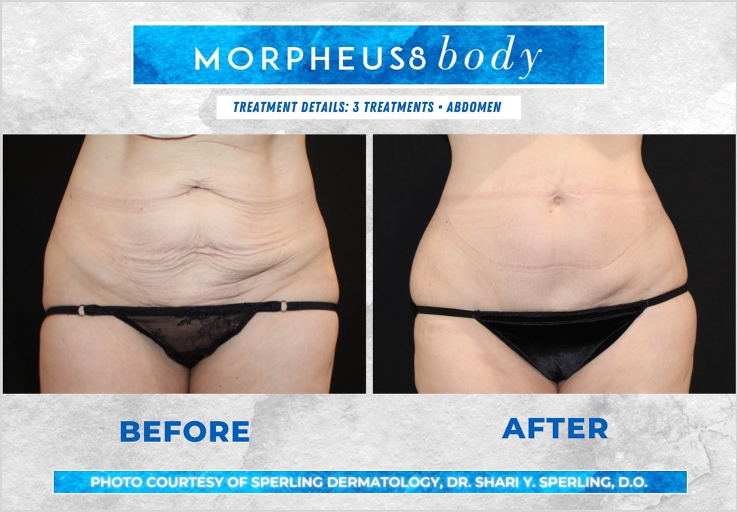 Before & After Abdomen Morpheus8 in New Jersey