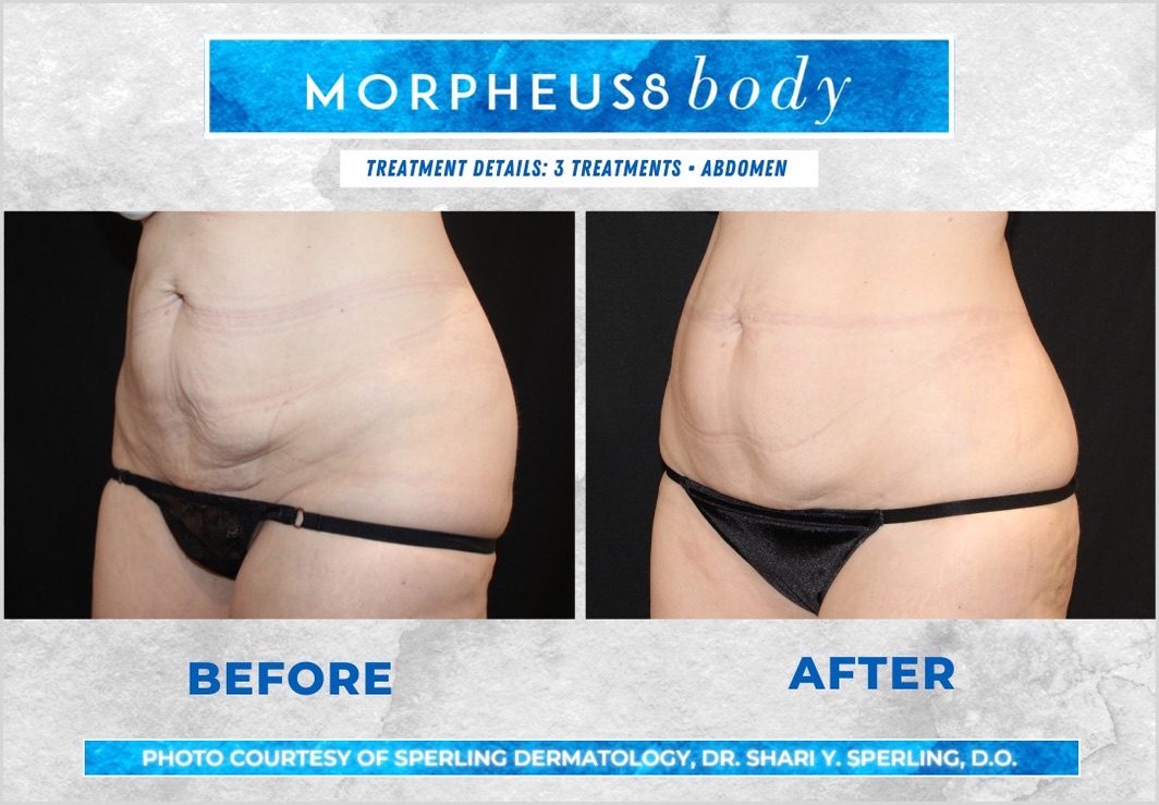 Before & After Abdomen Morpheus8 in New Jersey