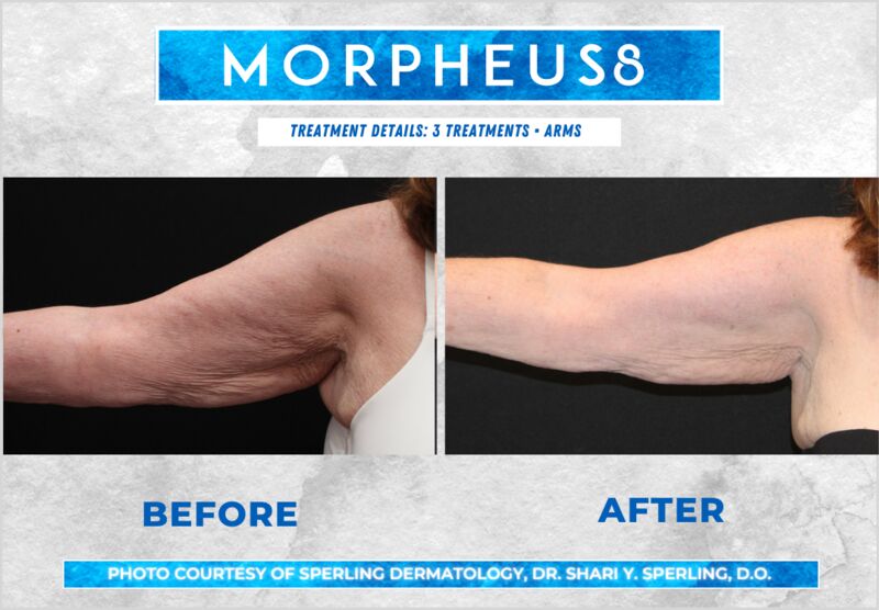 Before & After Arms Morpheus8 in New Jersey