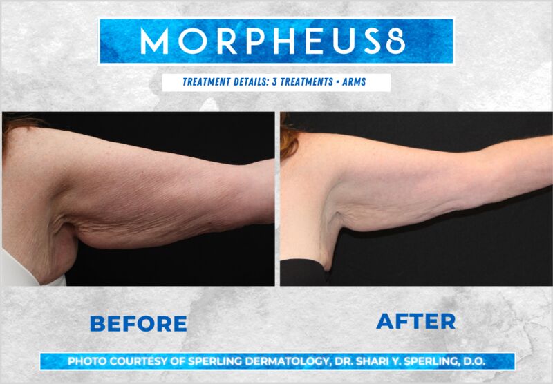 Before & After Arms Morpheus8 in New Jersey