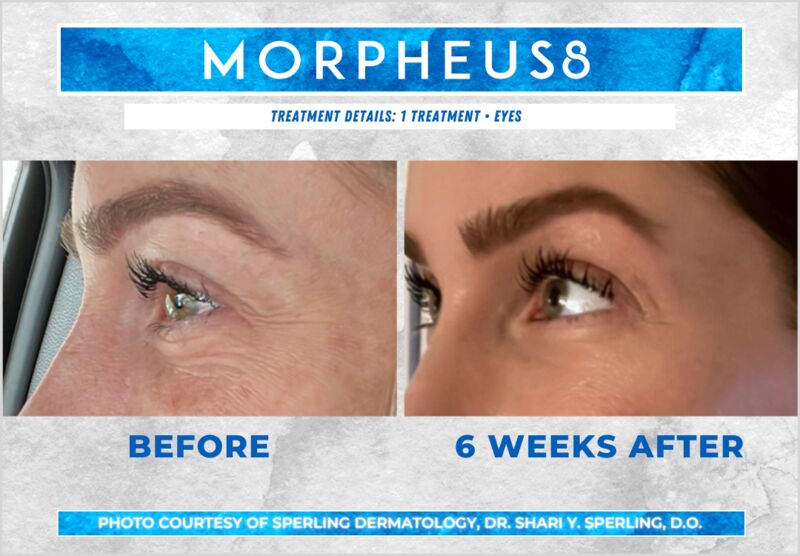 Before & After Eyes Morpheus8 in New Jersey