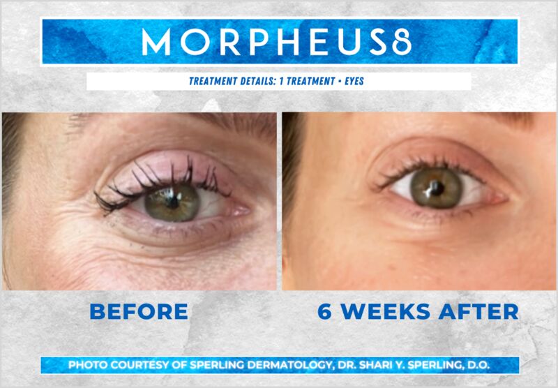 Before & After Eyes Morpheus8 in New Jersey