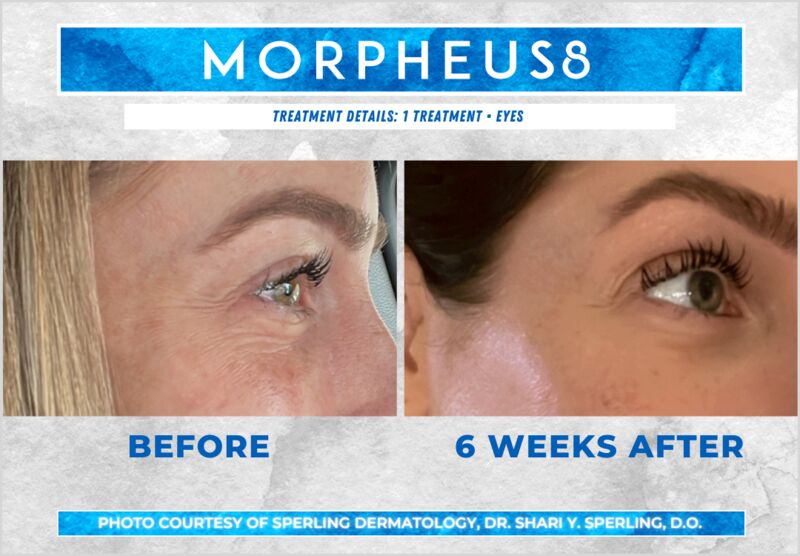 Before & After Eyes Morpheus8 in New Jersey