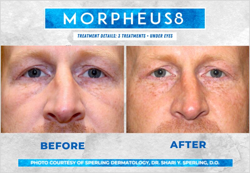 Before & After Eyes Morpheus8 in New Jersey