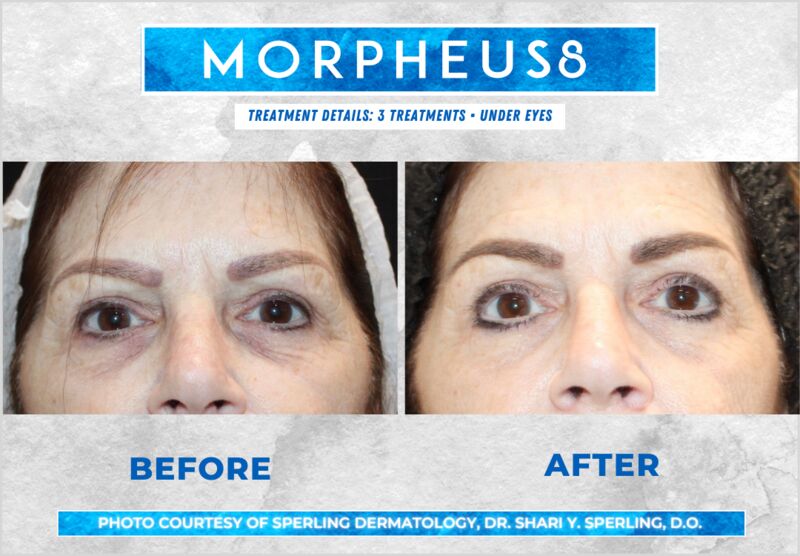 Before & After Eyes Morpheus8 in New Jersey