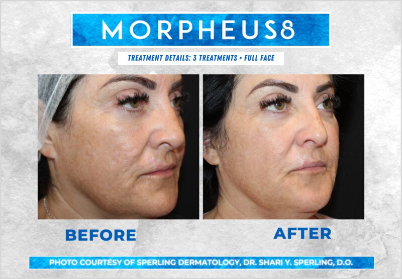 Before & After Full Face Morpheus8 in New Jersey