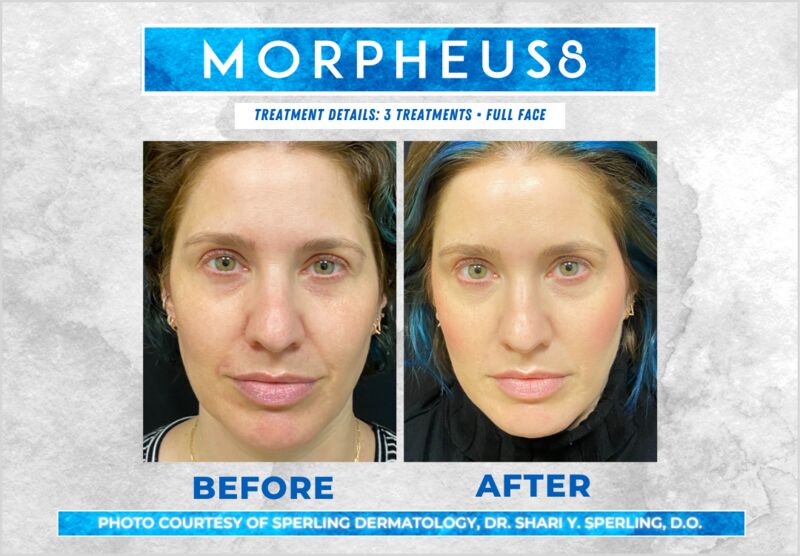 Before & After Full Face Morpheus8 in New Jersey