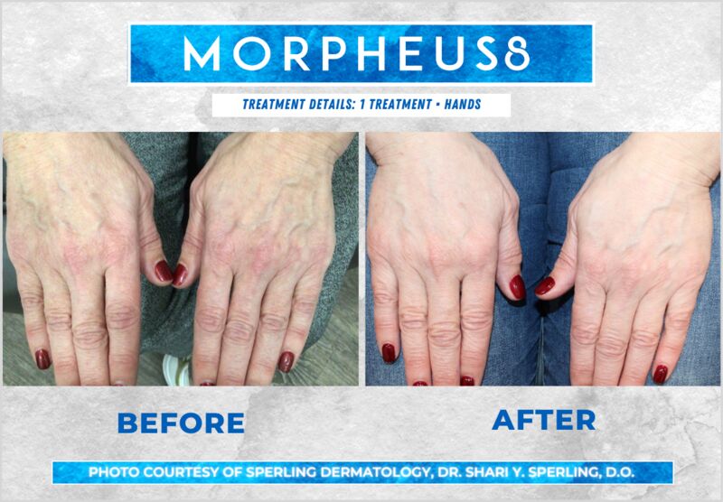 Before & After Hands Morpheus8 in New Jersey